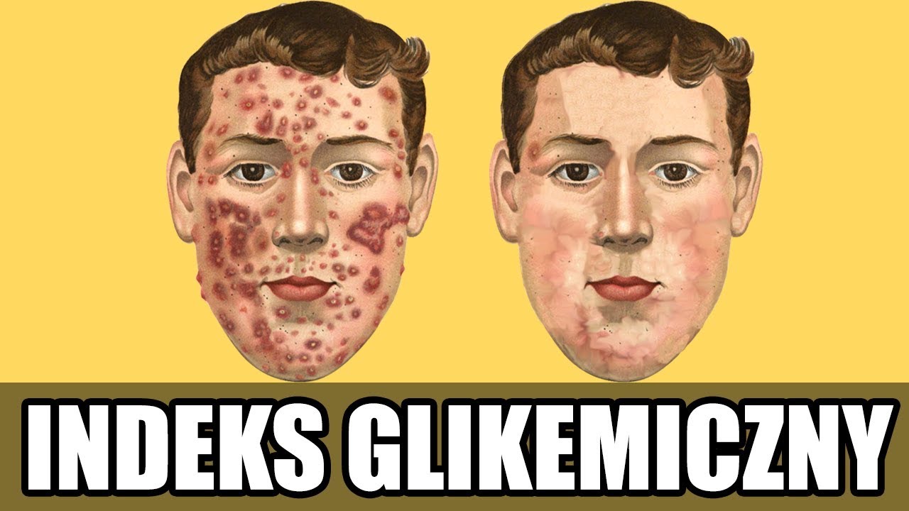 Antidotum na trądzik