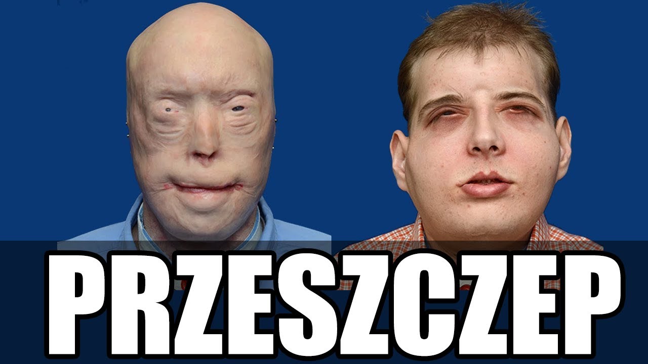 Najbardziej rozległy przeszczep w historii