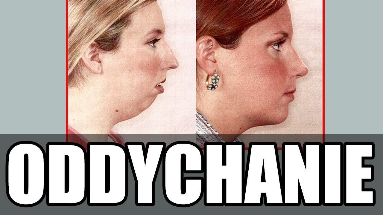 Wpływ oddychania przez usta na rozwój twarzy