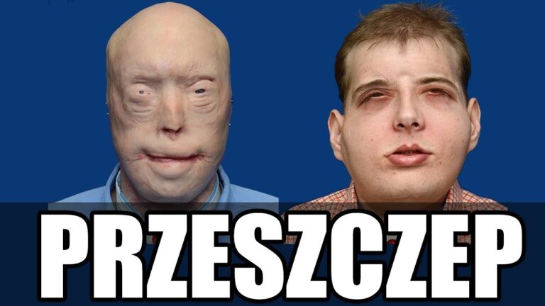 Najbardziej rozległy przeszczep w historii